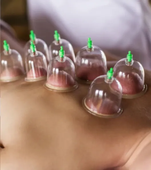 Cupping massage met vacuümcups